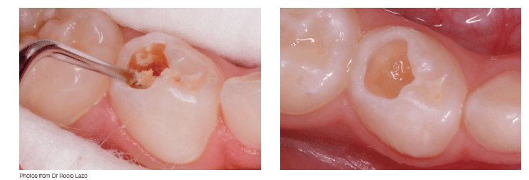 ART procedure with Biodentine- illustrative pictures from Dr Rocio Lazo